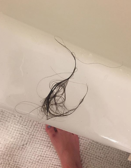 Hair would pull right out of my scalp w little to no force.