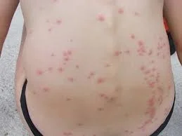 voici un exemple de ce que peut produire une infestation de punaises de lit.