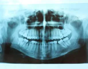 Root Canals