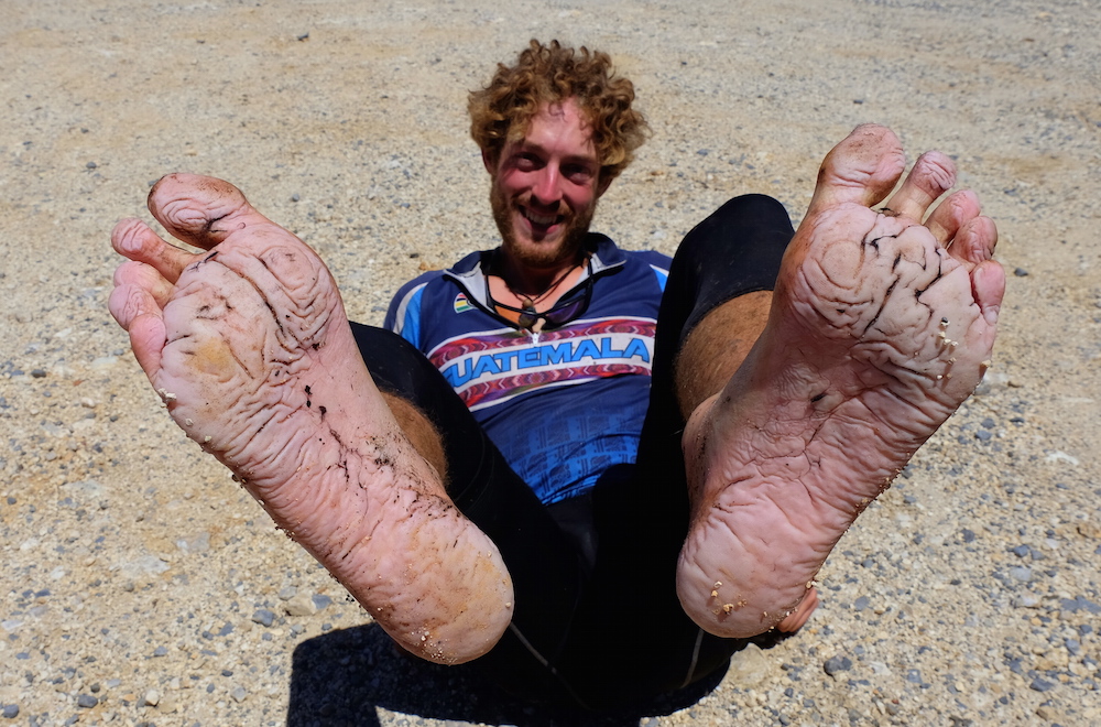 A classic case of the Trench Foot