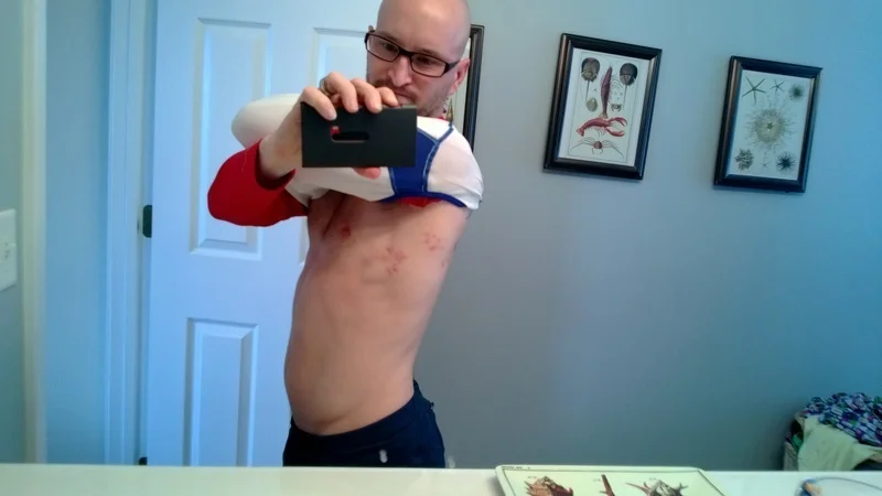 My Story with Shingles
