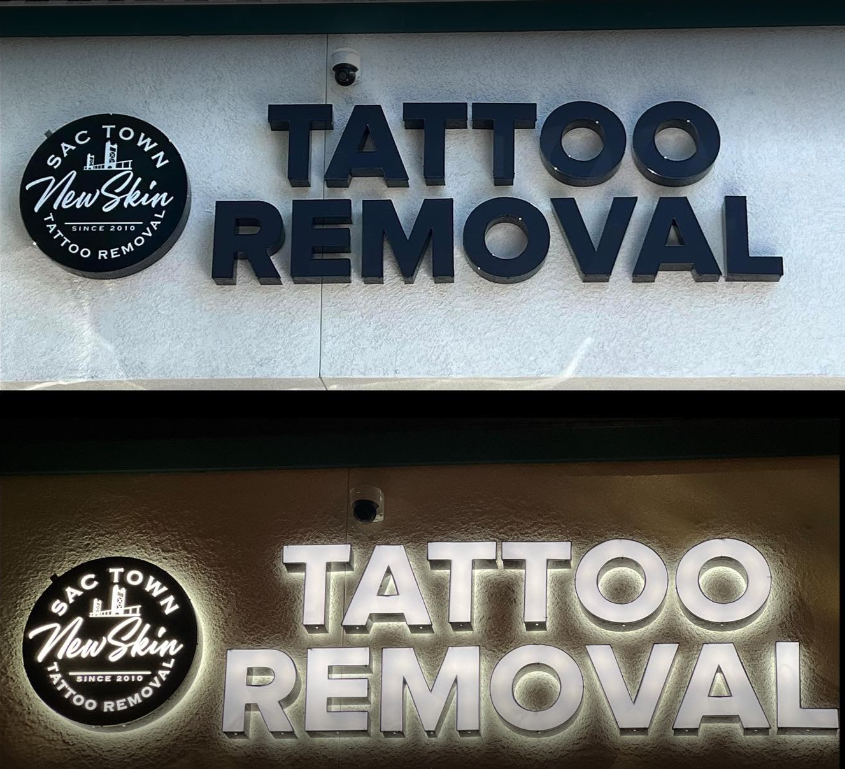 New Skin Tattoo Removal