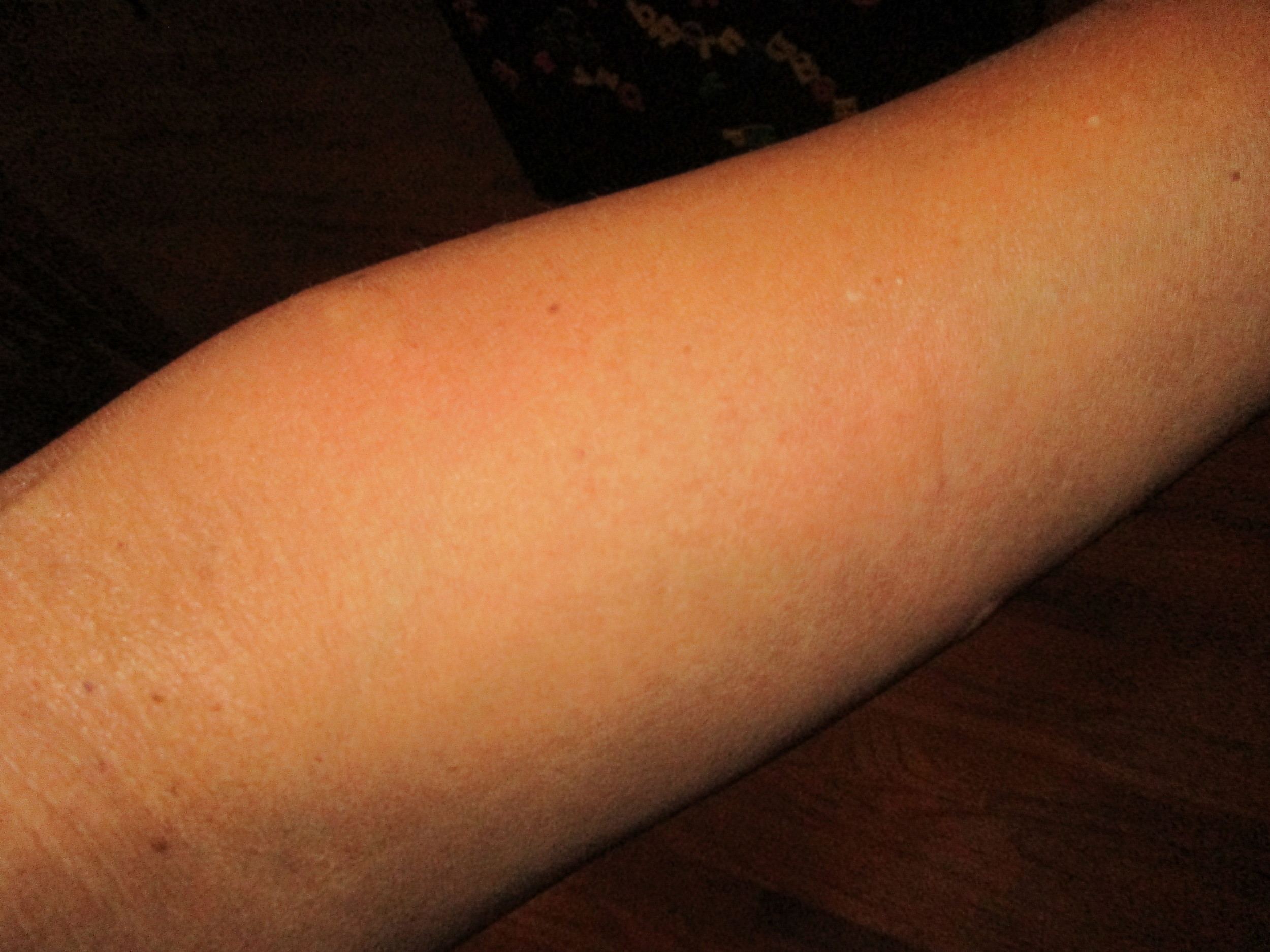 Maybe about 5 bee stings...