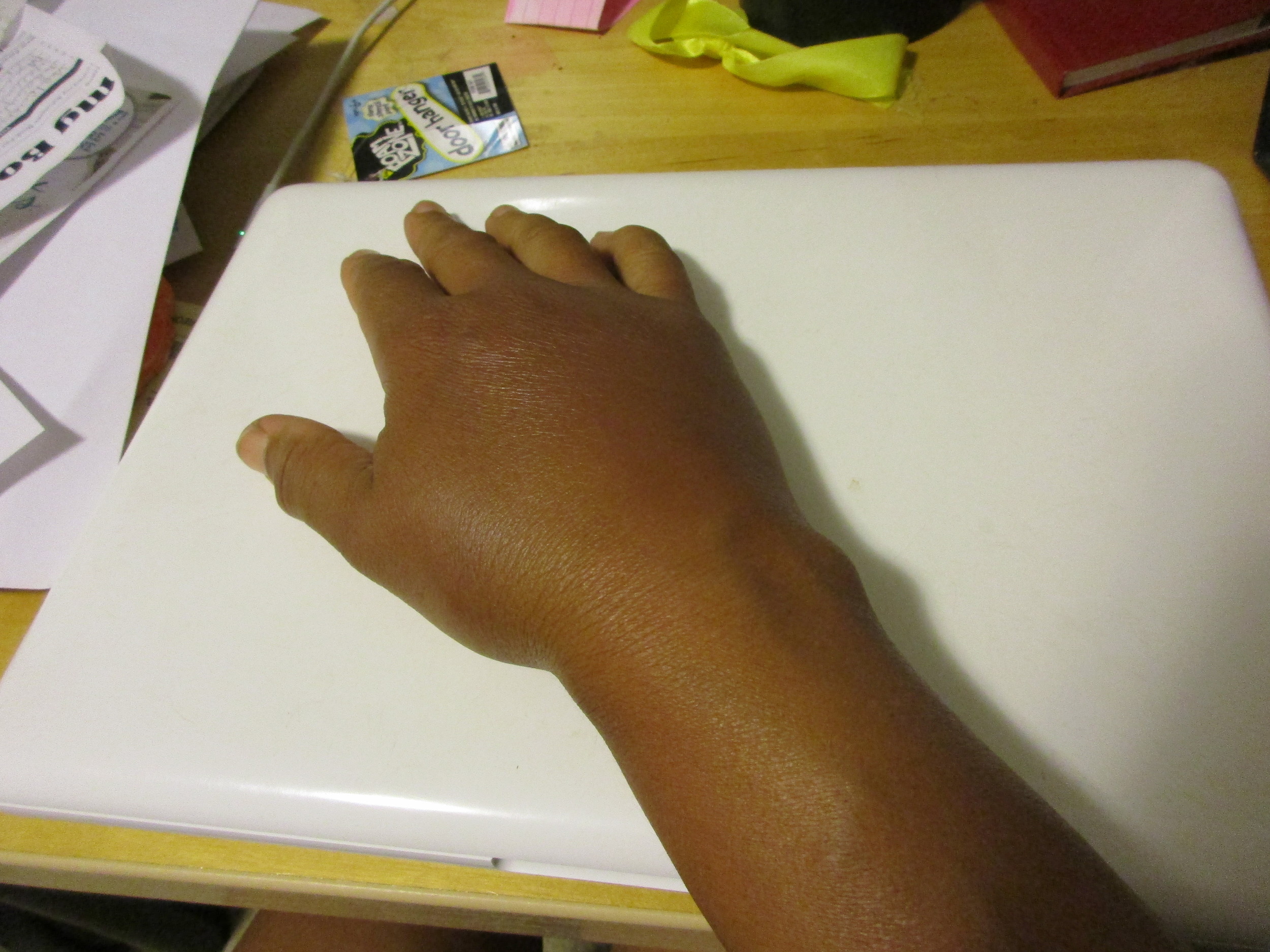 Right hand that got stung! The bee got me just above my thumb. Every time I looked I couldn't recognize my own hand!