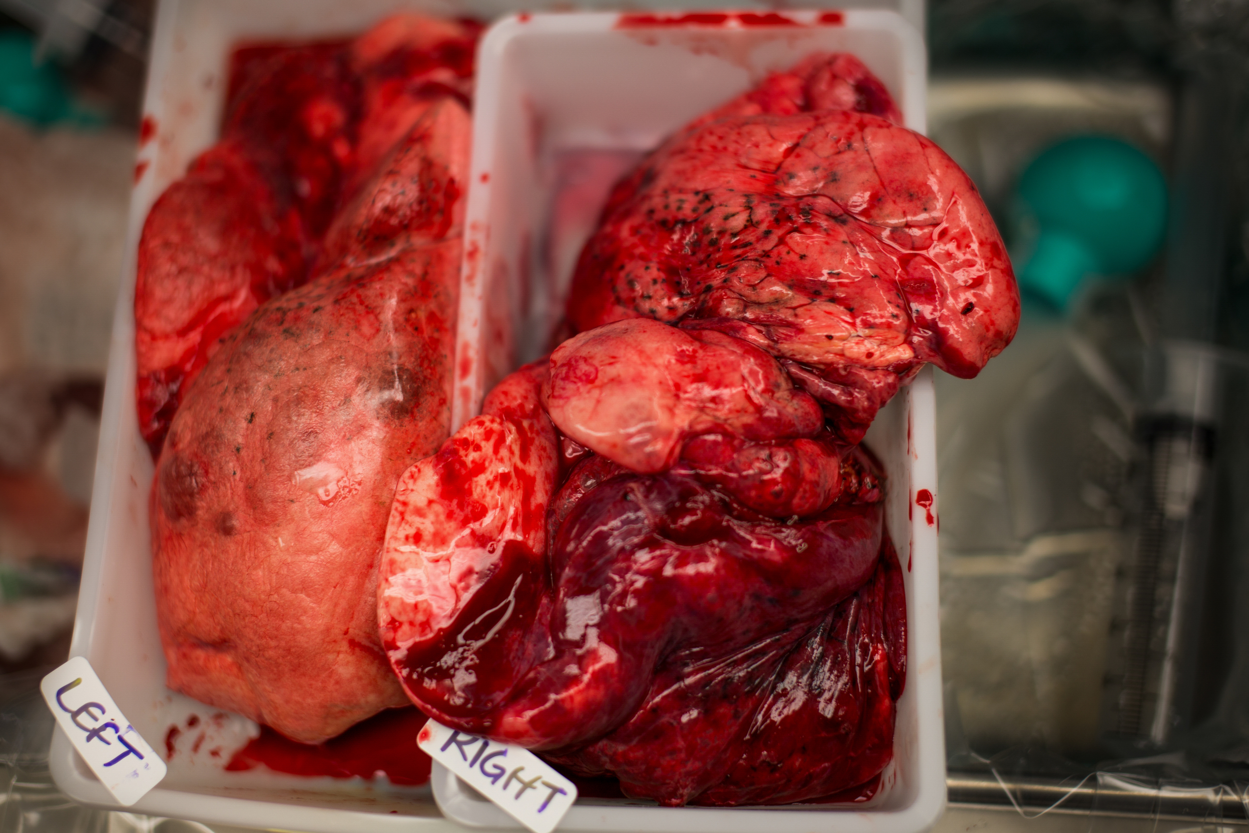 Autum's old lungs wait to be discarded after the operation. "The support group that I participate in and the people that have shared their experiences have been invaluable to me throughout this process," Autum said. "Maybe one day someb
