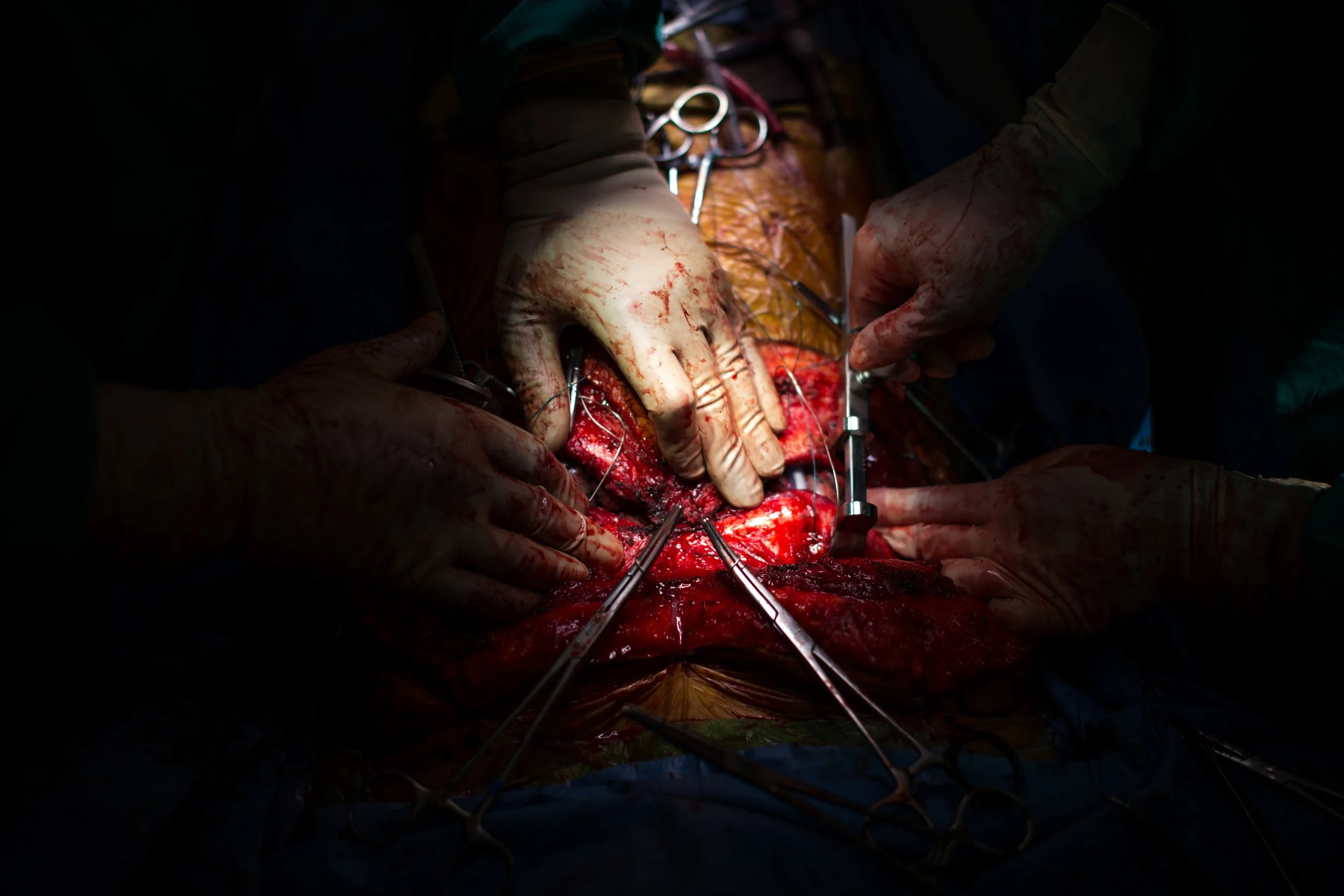  Dr. Mani Daneshmand leads in carefully closing Autum's chest after successfully transplanting her new lungs. 