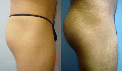 Buttock Implant Before & After Photo Gallery — Buttock (Butt