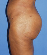 gershenbaum-buttock-post4.jpg