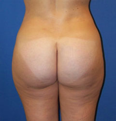 gershenbaum-buttock-post8b.jpg