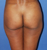 gershenbaum-buttock-pre1.jpg