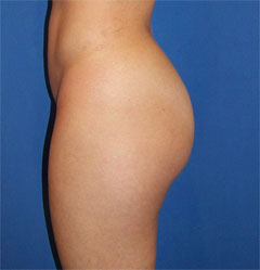 gershenbaum-buttock-pre8a.jpg