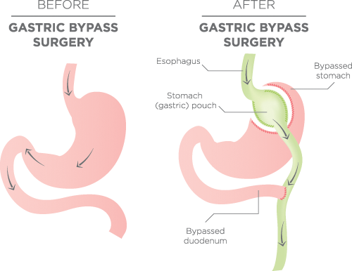 GastricBypass ObesityCareGroup.png                                