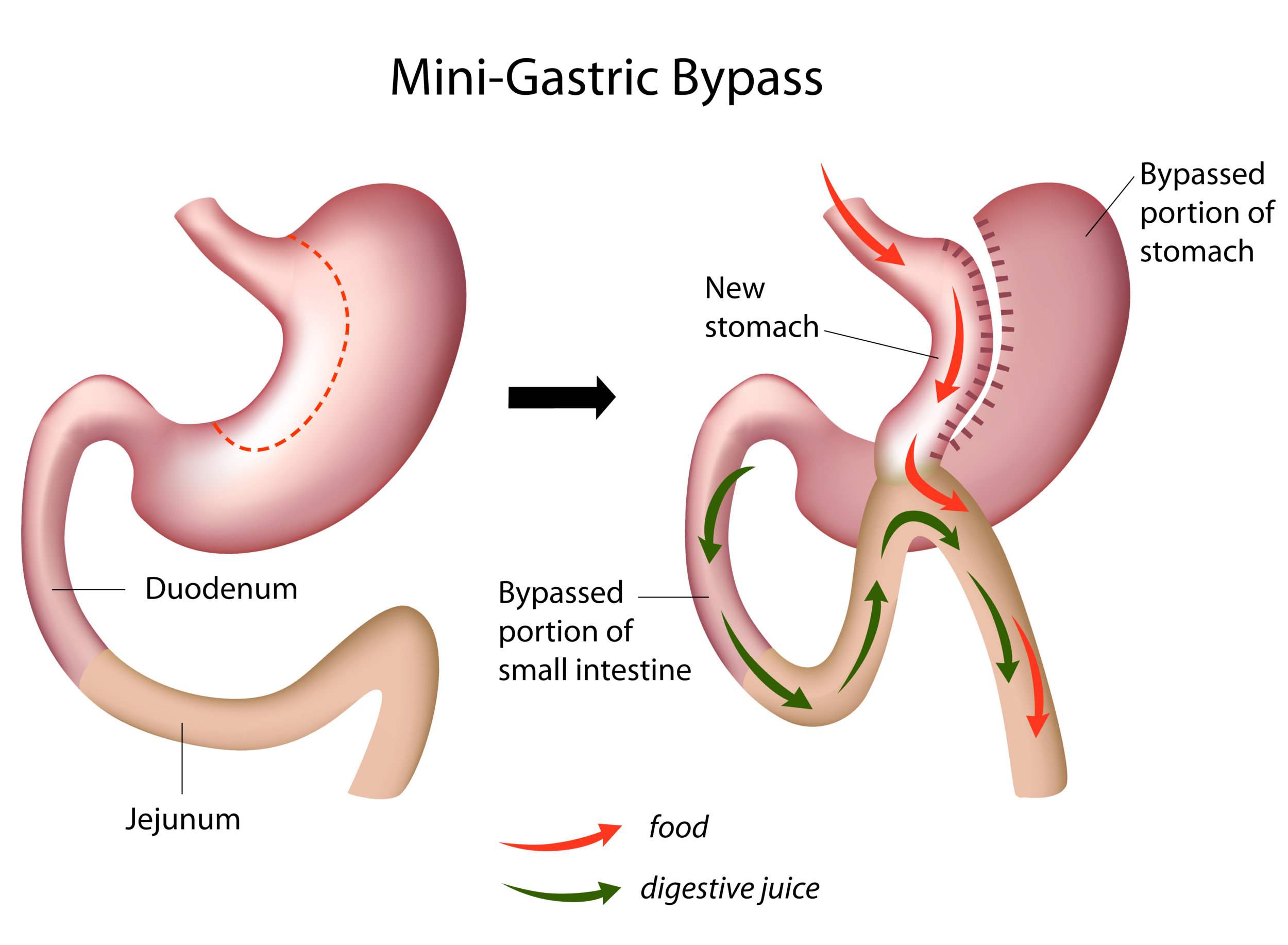Mini-bypass gástrico.png