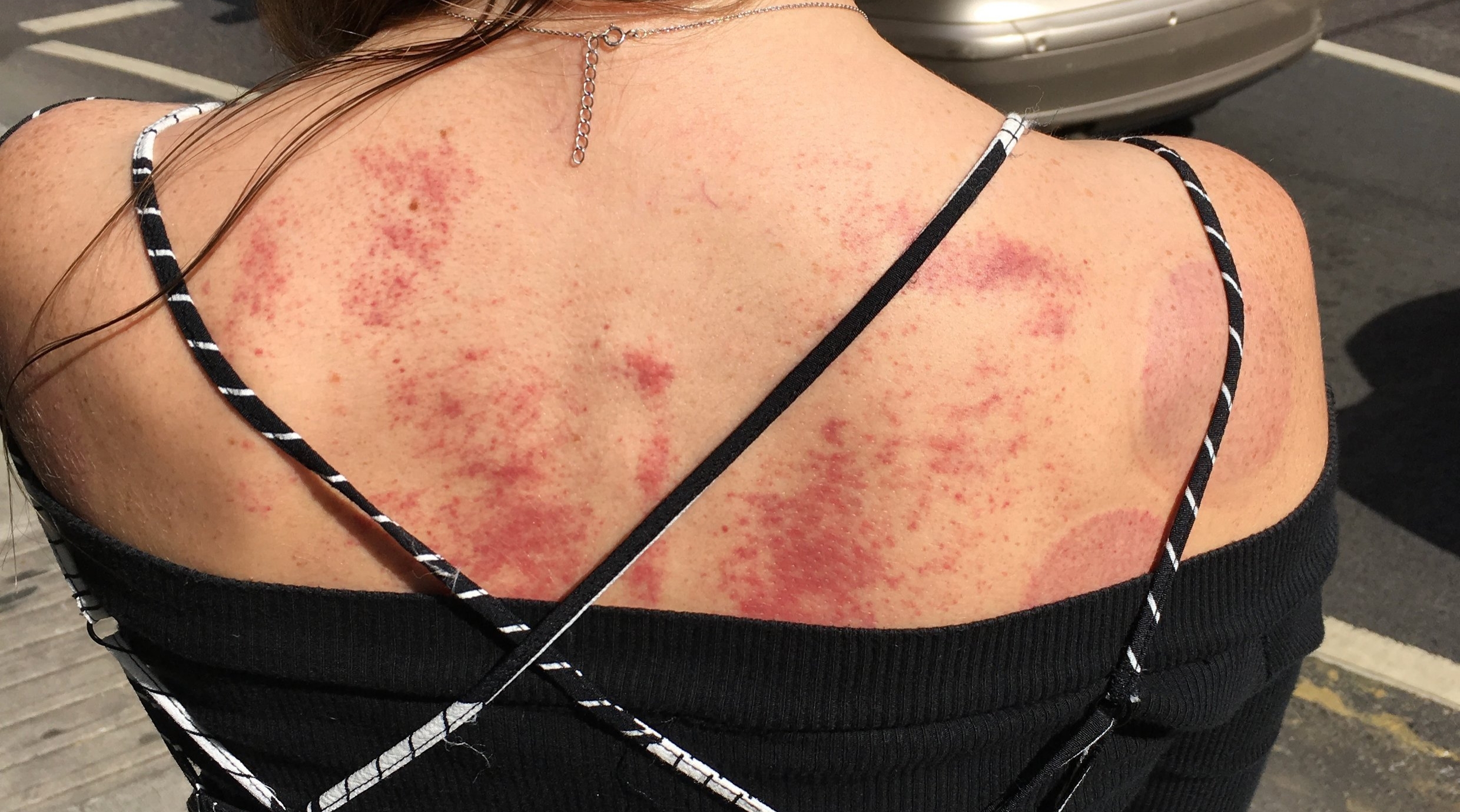 Light marks remain on the skin after a session of Gua Sha or Cupping. These will generally disappear within 3 to 5 days.