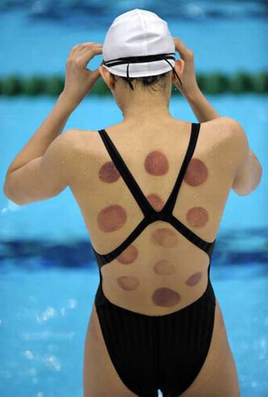 Cupping therapy was popular with swimmers at the Beijing Olympics.