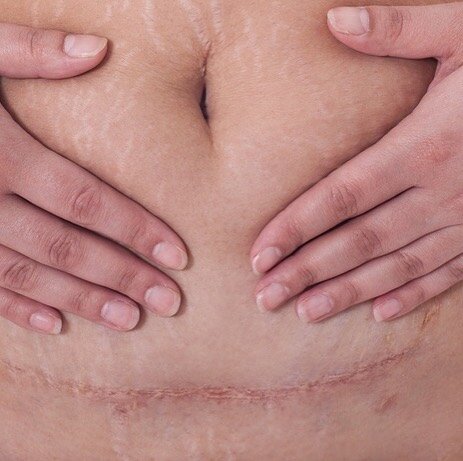 Caesarean Scars – Management of C-Section scars