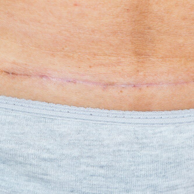 c-section scar.jpg