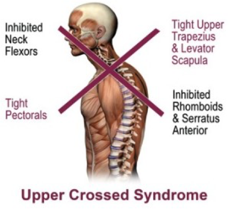 upper crossed syndrome - image demonstrating the cross of weak and tight muscles associated with upper crossed syndrome. 