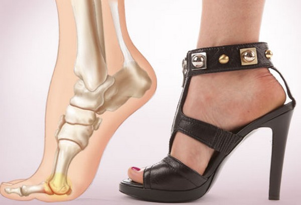 Doctors warn women over dangers of high heels | BelfastTelegraph.co.uk