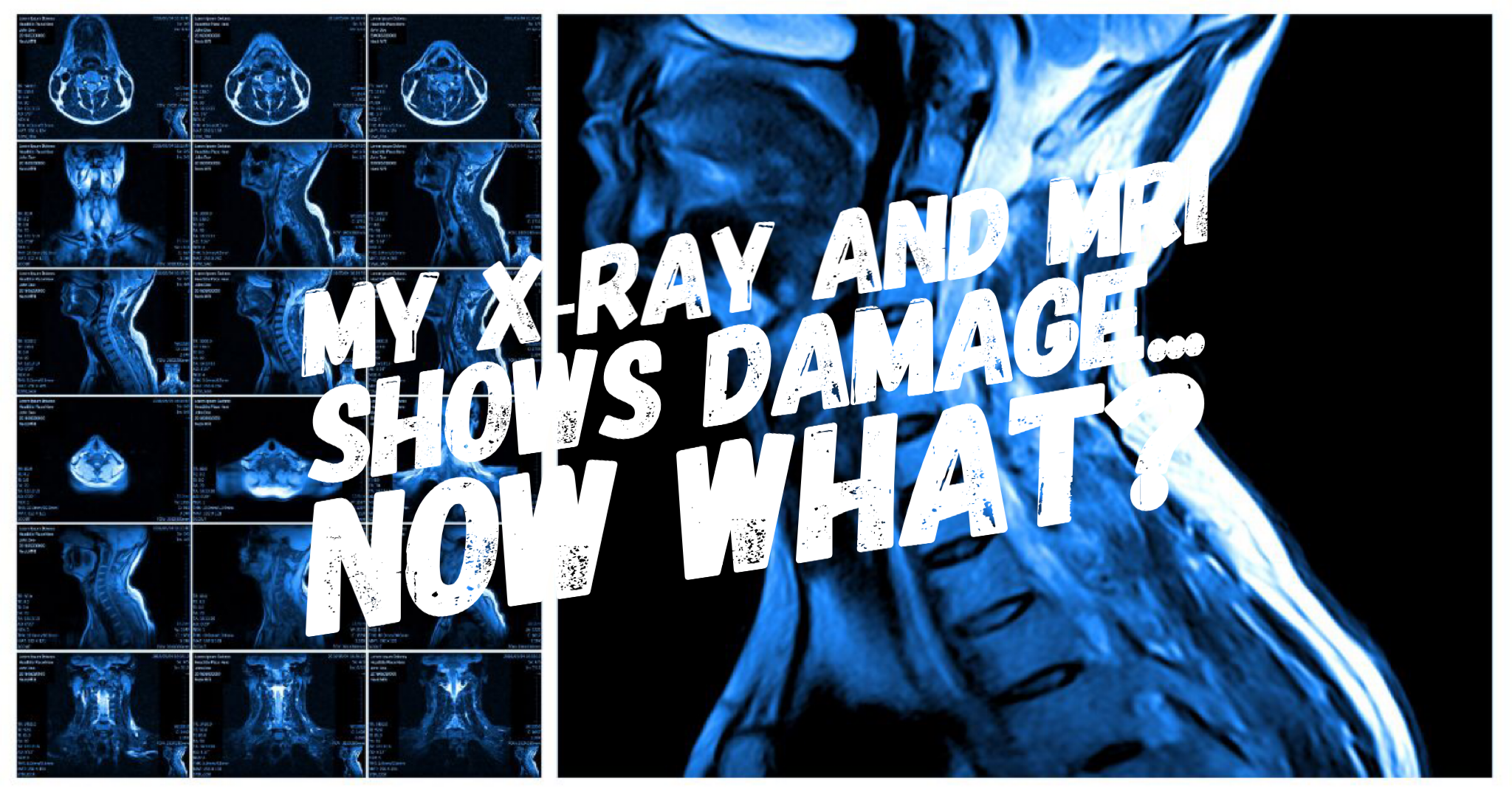 My X-Ray and MRI Shows “Damage”… Now What? 