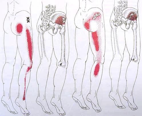 Sciatic Pain 02.jpg