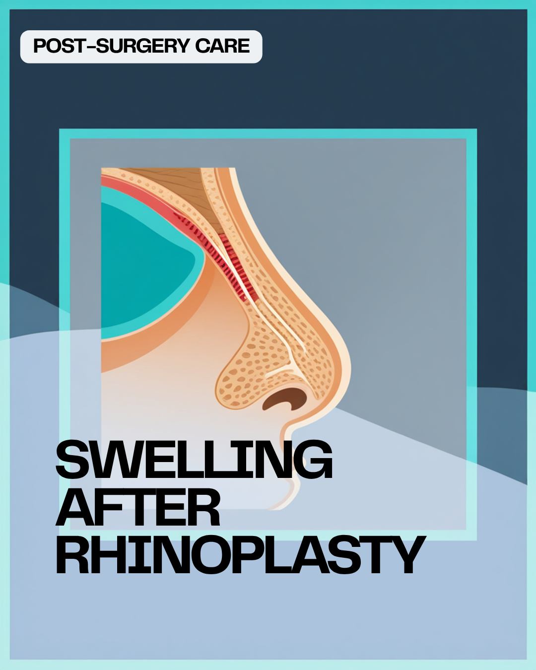 &nbsp;How Long Does Swelling Last After Rhinoplasty? The Honest Month-by-Month Answer
