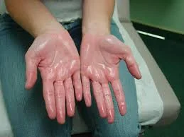 What is hyperhydrosis