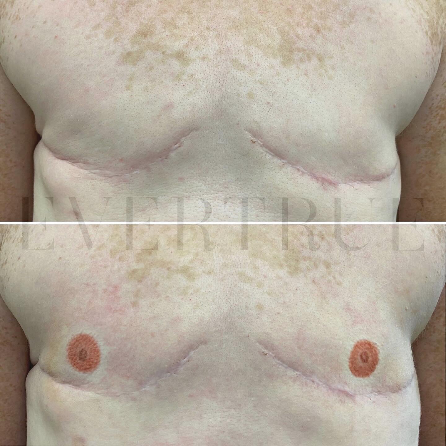 🎀 Areola &amp; Nipple Tattoos for our client who is a FTM breast cancer survivor. Very realistic results, a 3D effect created with color and shadow. 
.
Areola &amp; Nipple Tattoo by May (Senior Specialist, NYC). Procedure completed in one treatment 