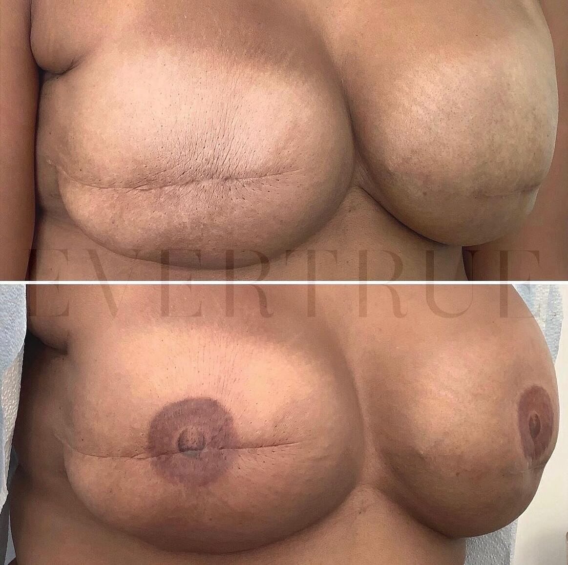 🎀 Areola &amp; Nipple Tattoos 🎀 Using our permanent makeup technique, we create the most realistic 3-D areola and nipple to complete the breast&hellip; the final step in a long journey of reconstruction, and a way for our breast cancer survivor cli