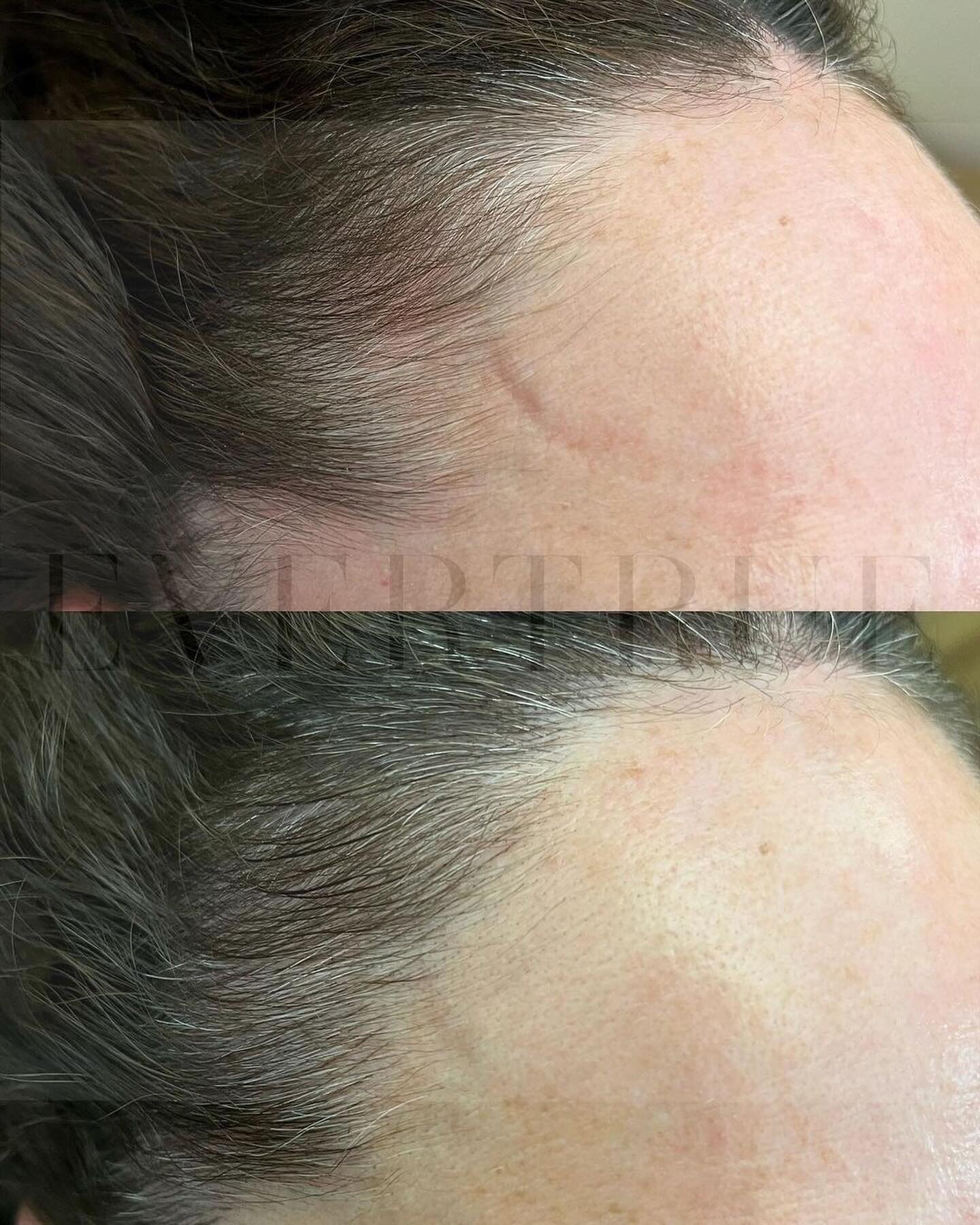 So natural! Instant hairline, with microbladed strokes that seamlessly blend in with existing hair strands. Close to miraculous solution to thinning hair. 
.
Hairline Rescue by Michelle (Master Therapist, NYC)
.
#hairline #hairlinerescue #hairlinetat
