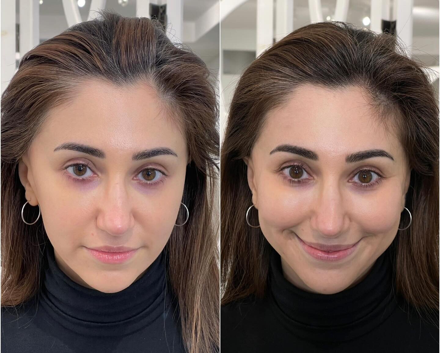 Hairline Microblading! Adding density and fullness just where you need it. Results are immediate, and we can customize exactly where you need that extra hairline help. 
.
Hairline Rescue by Kim (Senior Specialst, Chicago)
.
#hairline #hairlinerescue 