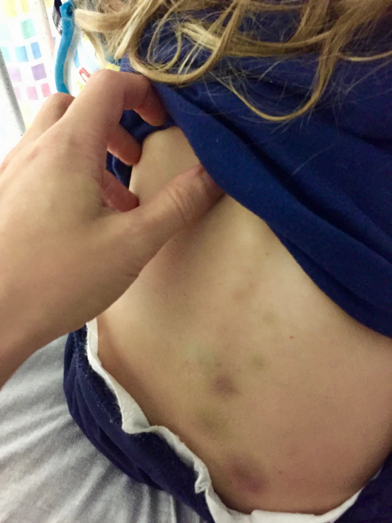 Spontaneous bruises from ITP that developed during Cooper’s hospital stay