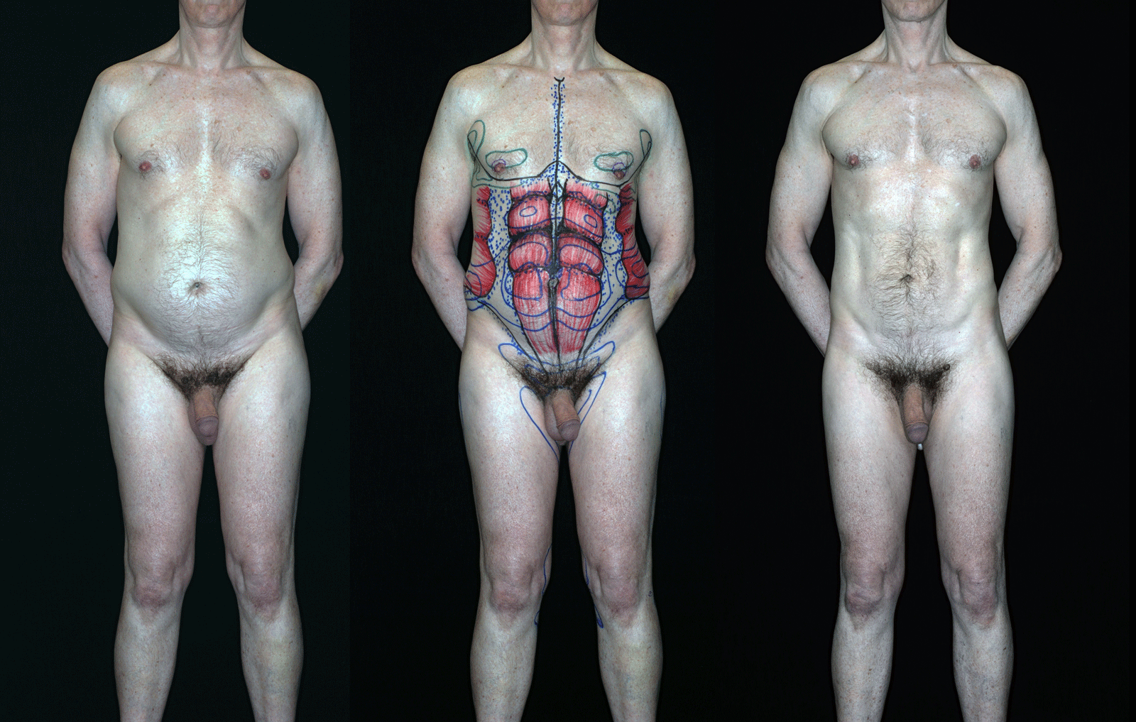 Teplica-Circumferential-Liposuction-0-Degree-View-reduced.gif