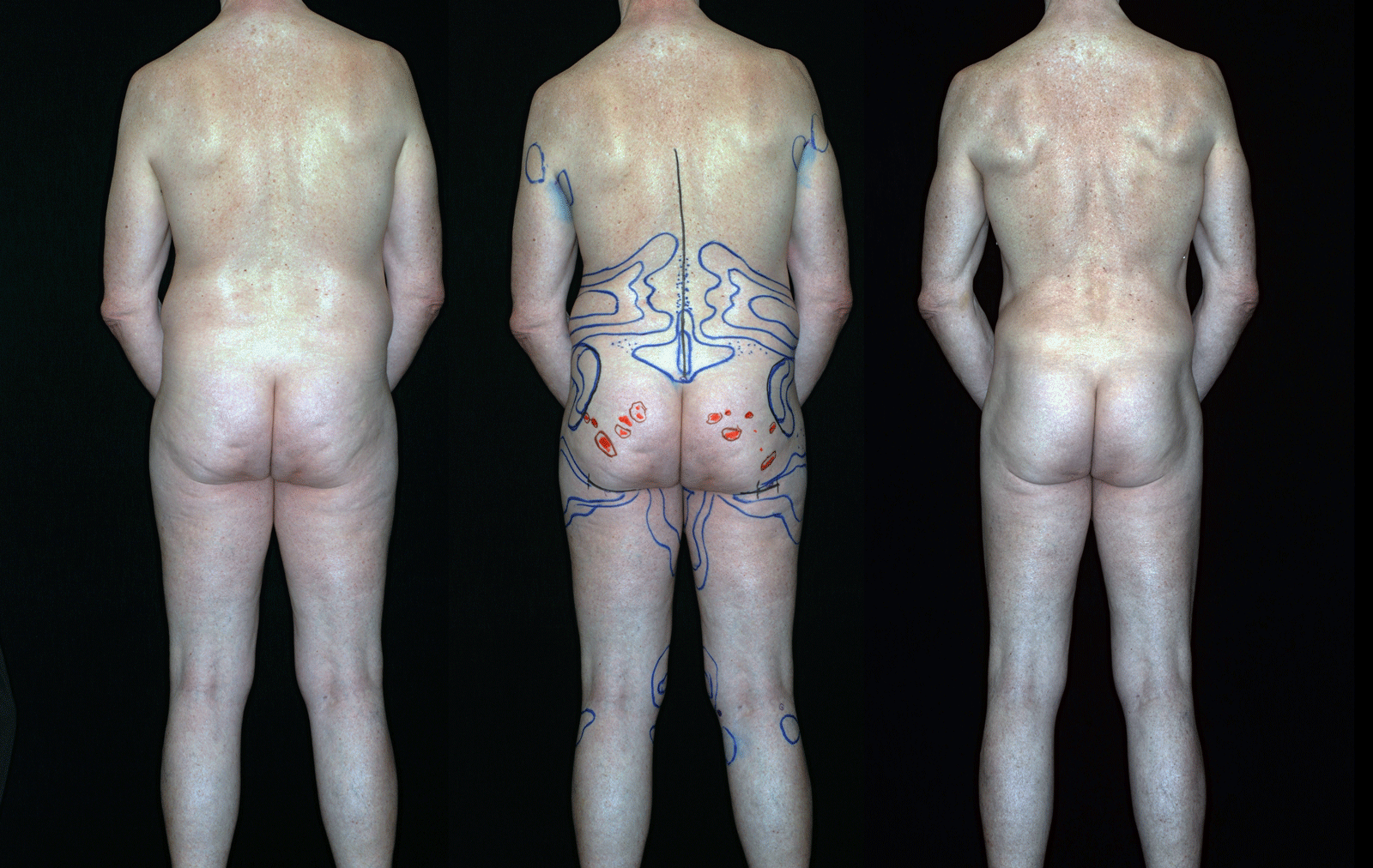 Teplica-Circumferential-Liposuction-180-Degree-View-reduced.gif