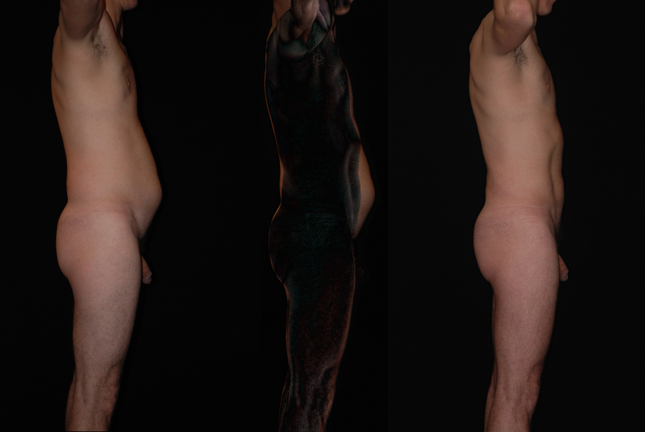 Anatomically-Based-Liposuction-Digital-Subtraction.gif