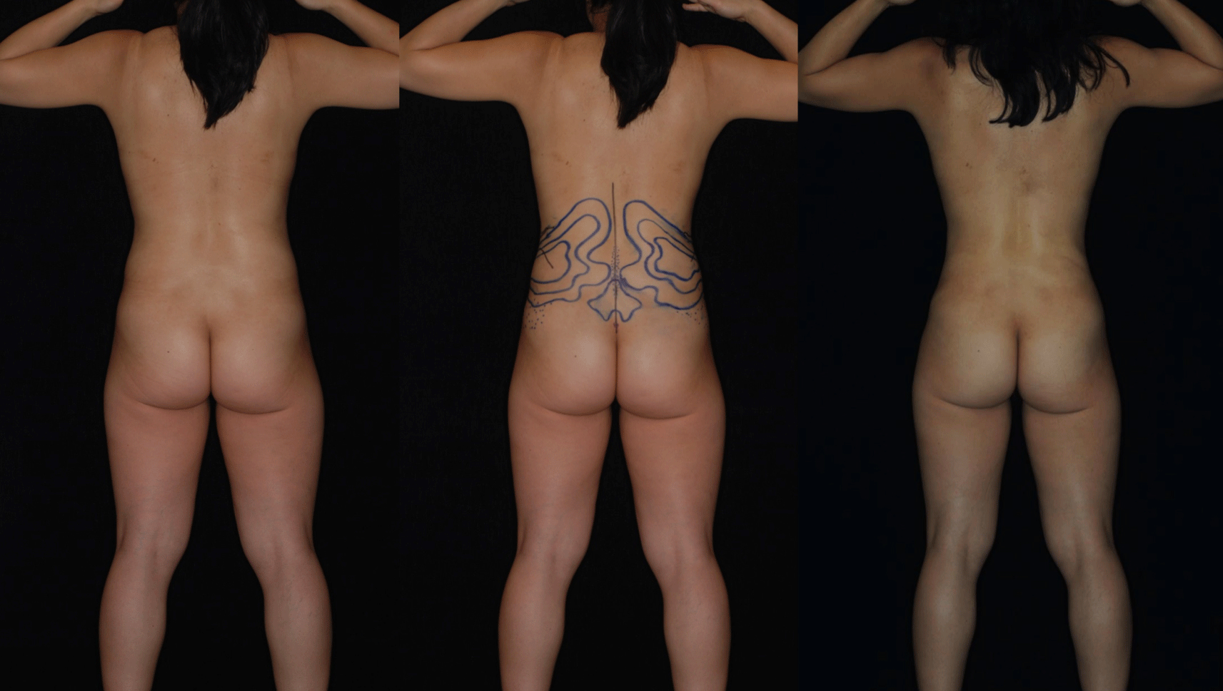 Teplica-3D-Abdominoplasty-180-Degrees.gif