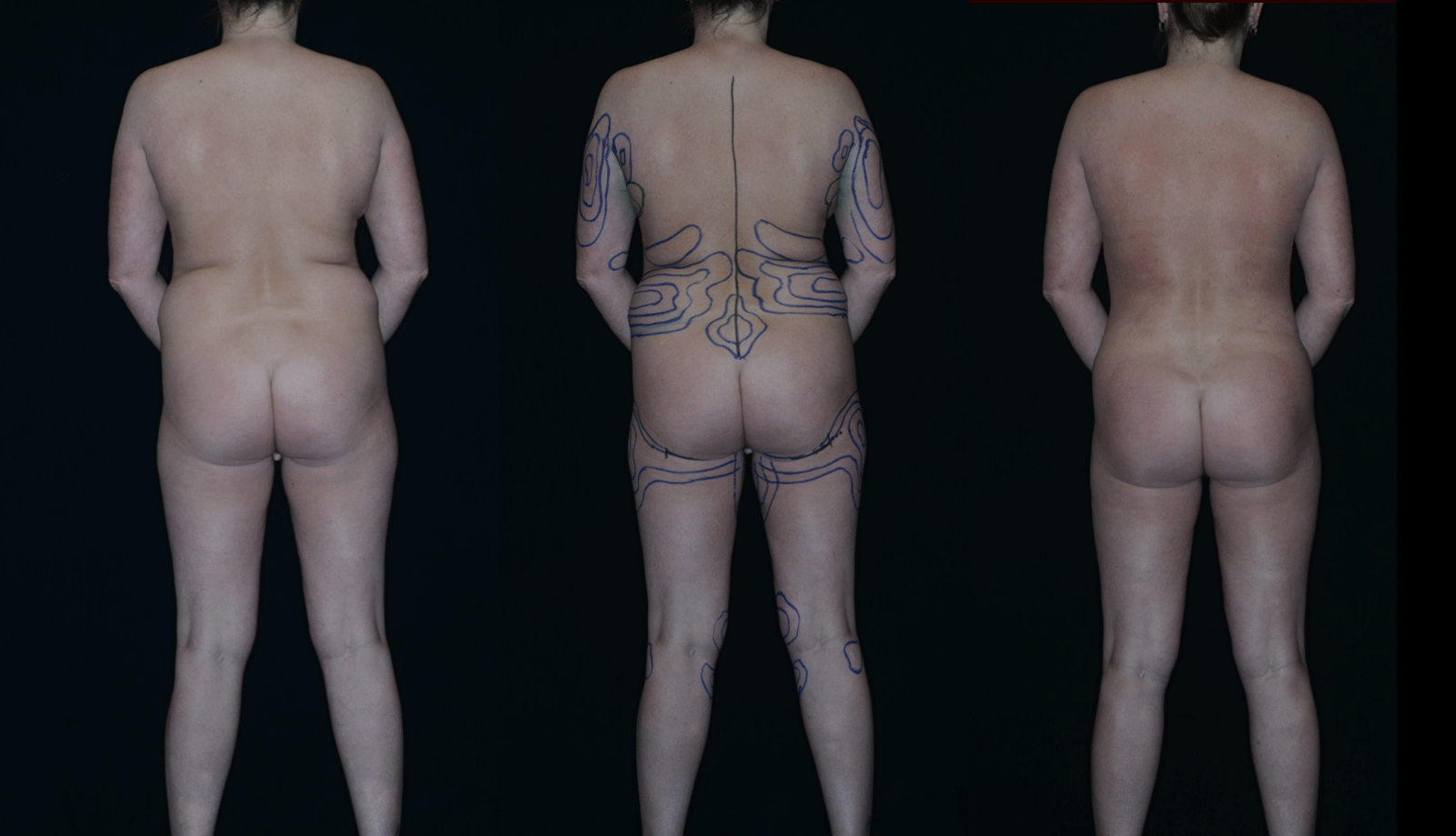 Teplica-Circumferential-Liposuction.gif