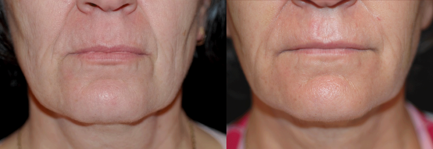 Teplica-Autologous-Fat-Transfer-Perioral-Wrinkles.gif