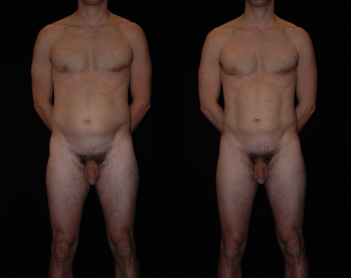 Teplica-Anatomically-Based-Liposuction.gif