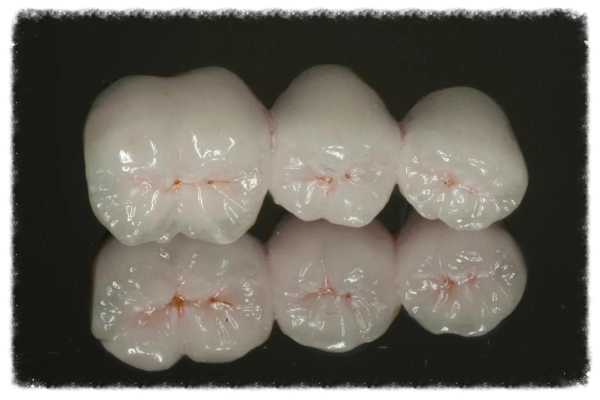White cosmetic bridge at Provident Dental Surgery in Worthing town centre. 