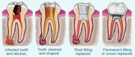Root Canal Treatment at Worthing Dental Clinic. Pain free root filling.