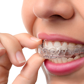 An example of an Essix retainer
