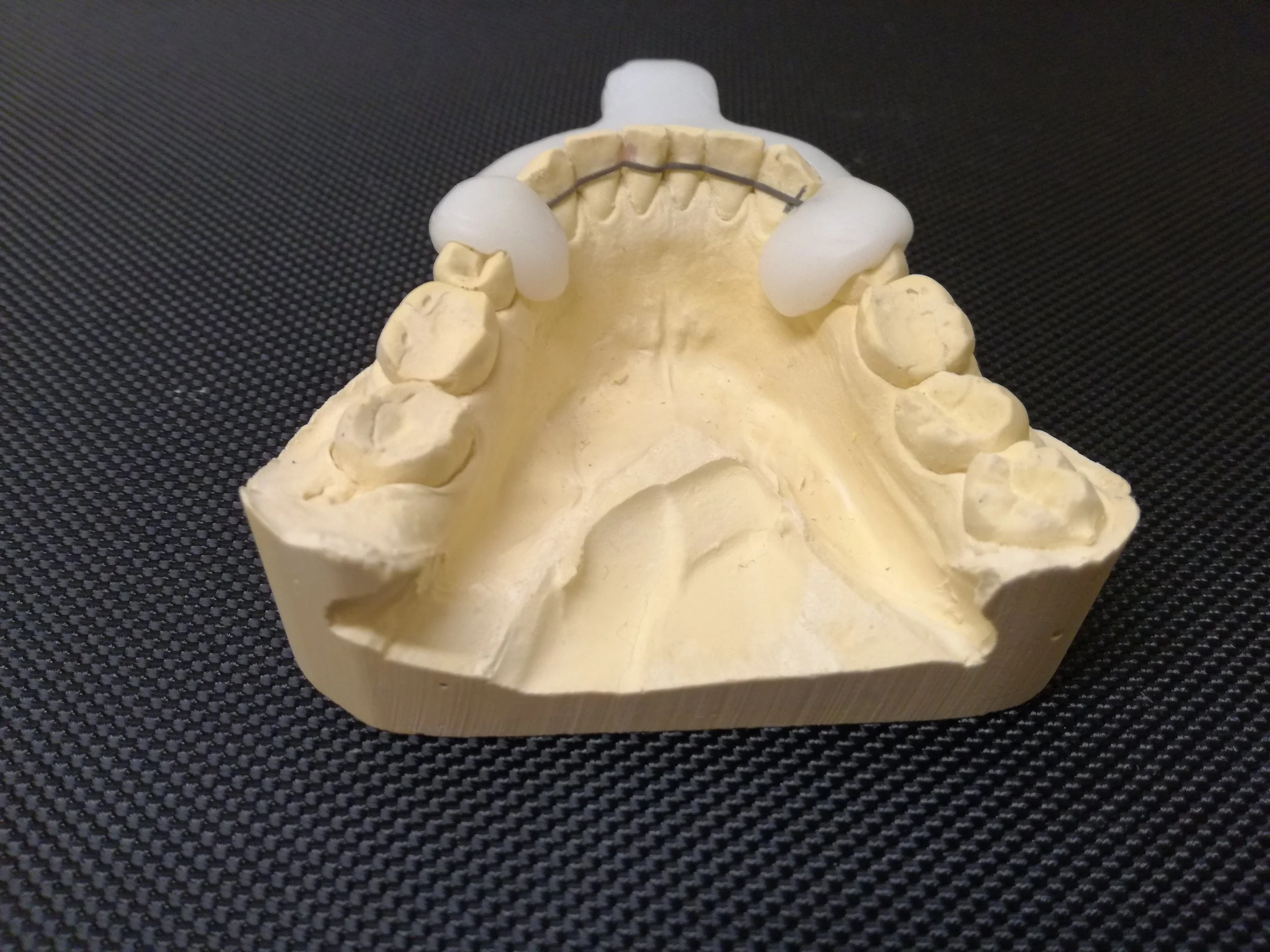 An example of a fixed retainer before fitting 