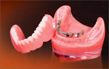 Sometimes a an Implant Denture/Over Denture will need a retention bar to make it stronger. This is shown in the picture.