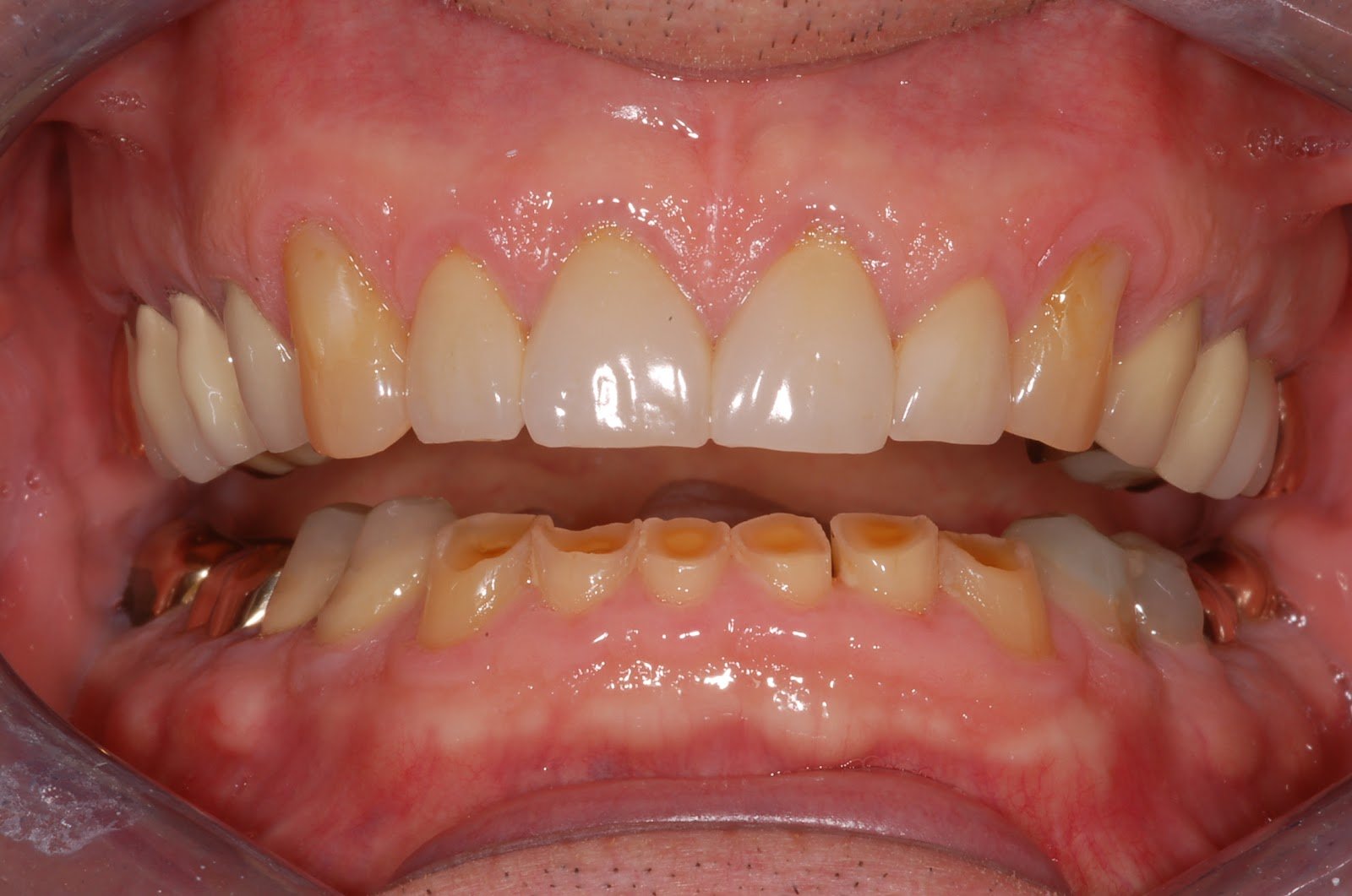 A Guide to Wear-Down Teeth: Signs, Symptoms, and Dental Treatments