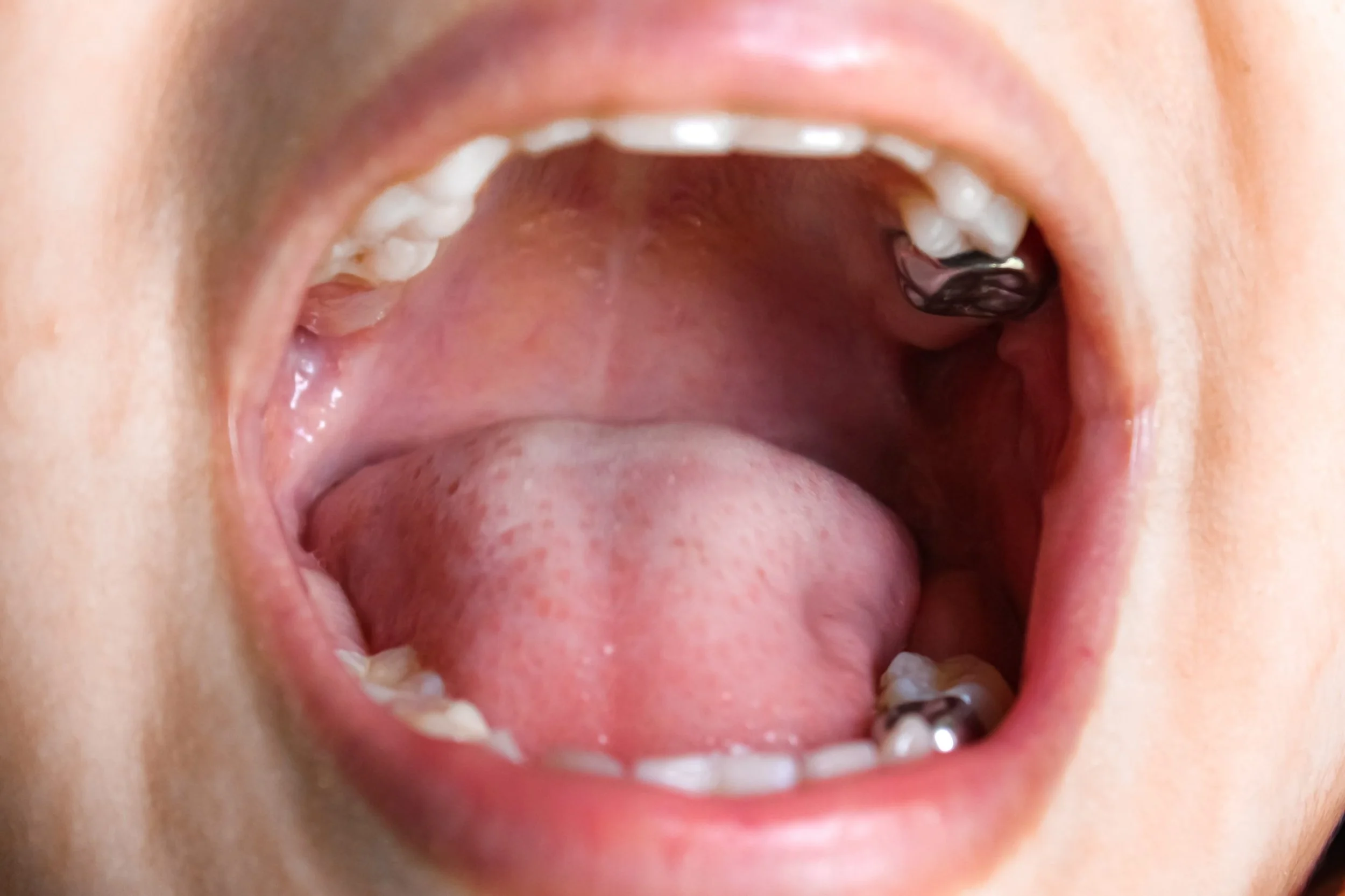 What is Root canal treatment?