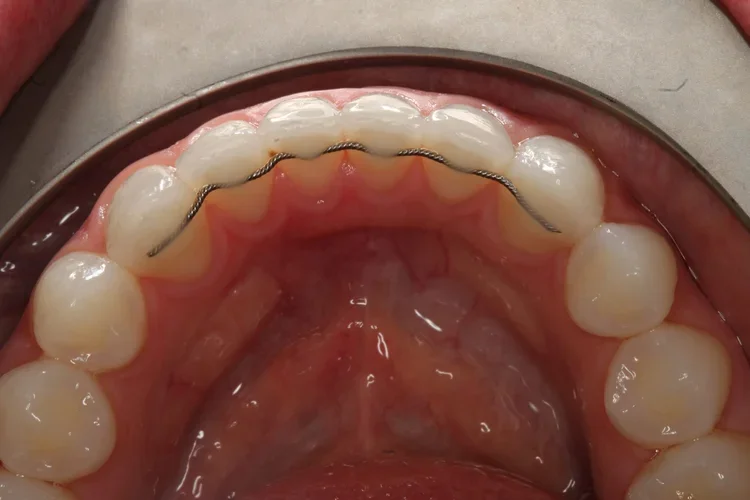 Orthodontic Retainers: Types, How Long to Wear Them, and How to Care for Them (Worthing)