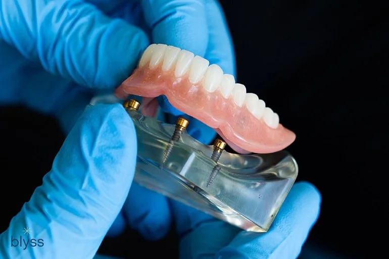 Snap-In Dentures Cost in the UK (2026): Price Ranges, Options and Ongoing Costs