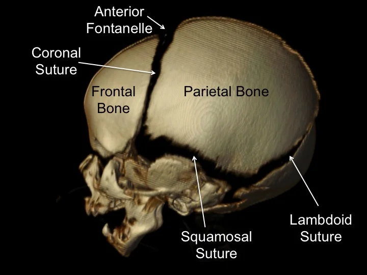 What Is Craniosynostosis Dallas Plastic Surgeon Specializing In Rhinoplasty Septoplasty Cleft Rhinoplasty Cleft Lip Revision And Ear Surgery