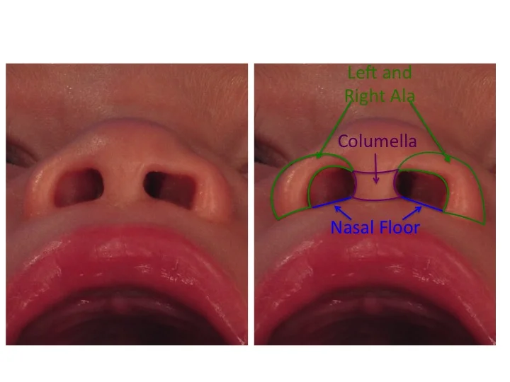 Cleft Nasal Anatomy — Dallas Plastic Surgeon specializing in Rhinoplasty, Septoplasty, Cleft